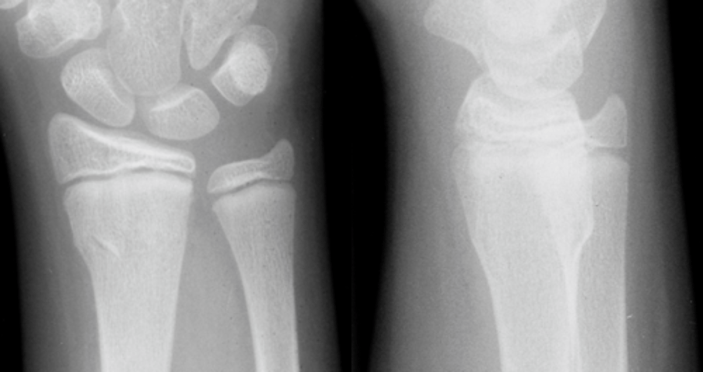 <p>Inclination of the distal radius with volar tilt</p>
