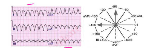 <p><strong>Northwest/Indeterminate Deviation</strong></p><p>-The QRS complex is ________ in lead I and _________ in lead aVF<strong> </strong></p>