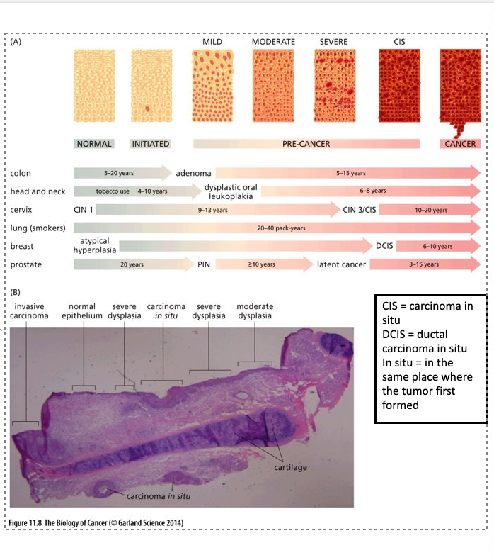 <ul><li><p class="Paragraph WhiteSpaceCollapse SCXP115642297 BCX0" style="text-align: left"><span>Succession depicted in previous figure is not always followed; i.e. some tumors skip steps or tumors never develop from intermediates like adenomas​</span></p></li><li><p class="Paragraph WhiteSpaceCollapse SCXP115642297 BCX0" style="text-align: left"><span>Panel (A): tumorigenesis similar in other tumors; nomenclature is different​</span></p></li><li><p class="Paragraph WhiteSpaceCollapse SCXP115642297 BCX0" style="text-align: left"><span>Panel (B): On rare occasions a tissue displaying multiple stages of cancer progression co-existing can be found​</span></p></li></ul><p class="Paragraph WhiteSpaceCollapse SCXP115642297 BCX0" style="text-align: left"></p><p class="Paragraph WhiteSpaceCollapse SCXP115642297 BCX0" style="text-align: left">CIS- carcinoma in situ</p><p class="Paragraph WhiteSpaceCollapse SCXP115642297 BCX0" style="text-align: left">DCIS- ductal carcinoma in situ</p><p class="Paragraph WhiteSpaceCollapse SCXP115642297 BCX0" style="text-align: left">In situ- in the same place where the tumor first formed</p><p></p>