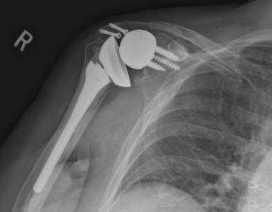 <p>Indications for Reverse Total Shoulder, (advantages are you don’t need RC)</p>