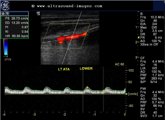 <p>Considering artery, location of sample volume and waveform, is this a normal waveform? </p><p>1.If disease is present, where is it?</p><p>2.Proximal or distal to sample volume?</p>