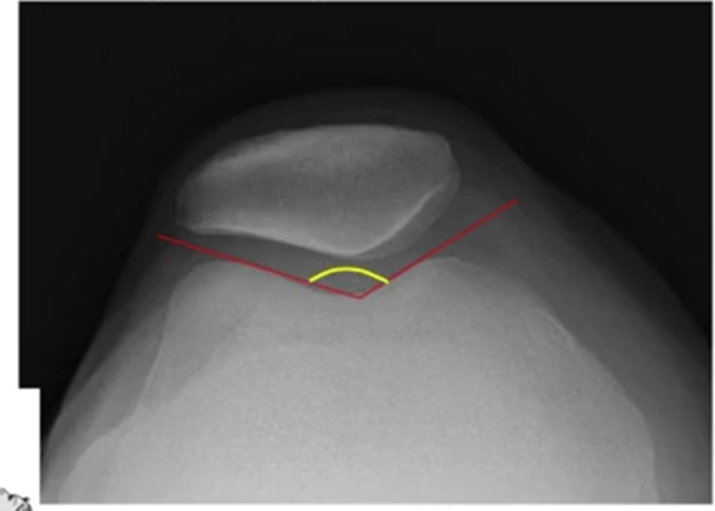 <p>the greater the angle = greater chance of dislocation</p>