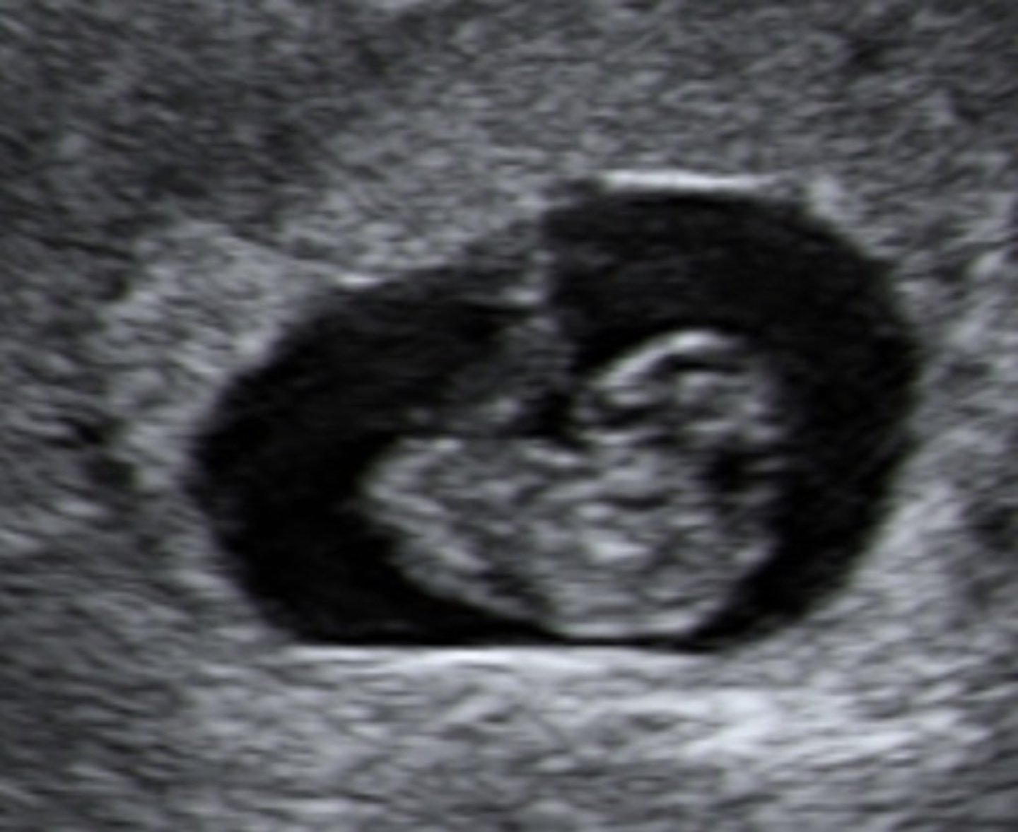 <p>Large head</p><p>Brain hemispheres start to develop + has 3 brain vesicles</p><p>Spine straightens</p>