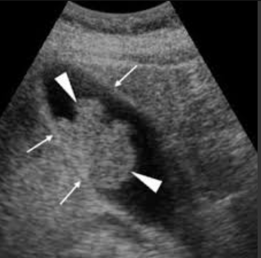 <p>Benign epithelial tumor; &lt;1cm usually; pre malignant if &gt;1cm </p><p></p><p>Non-mobile, non-shadowing Echogenic polyploid lesion; smooth contours; color Doppler may show flow </p>