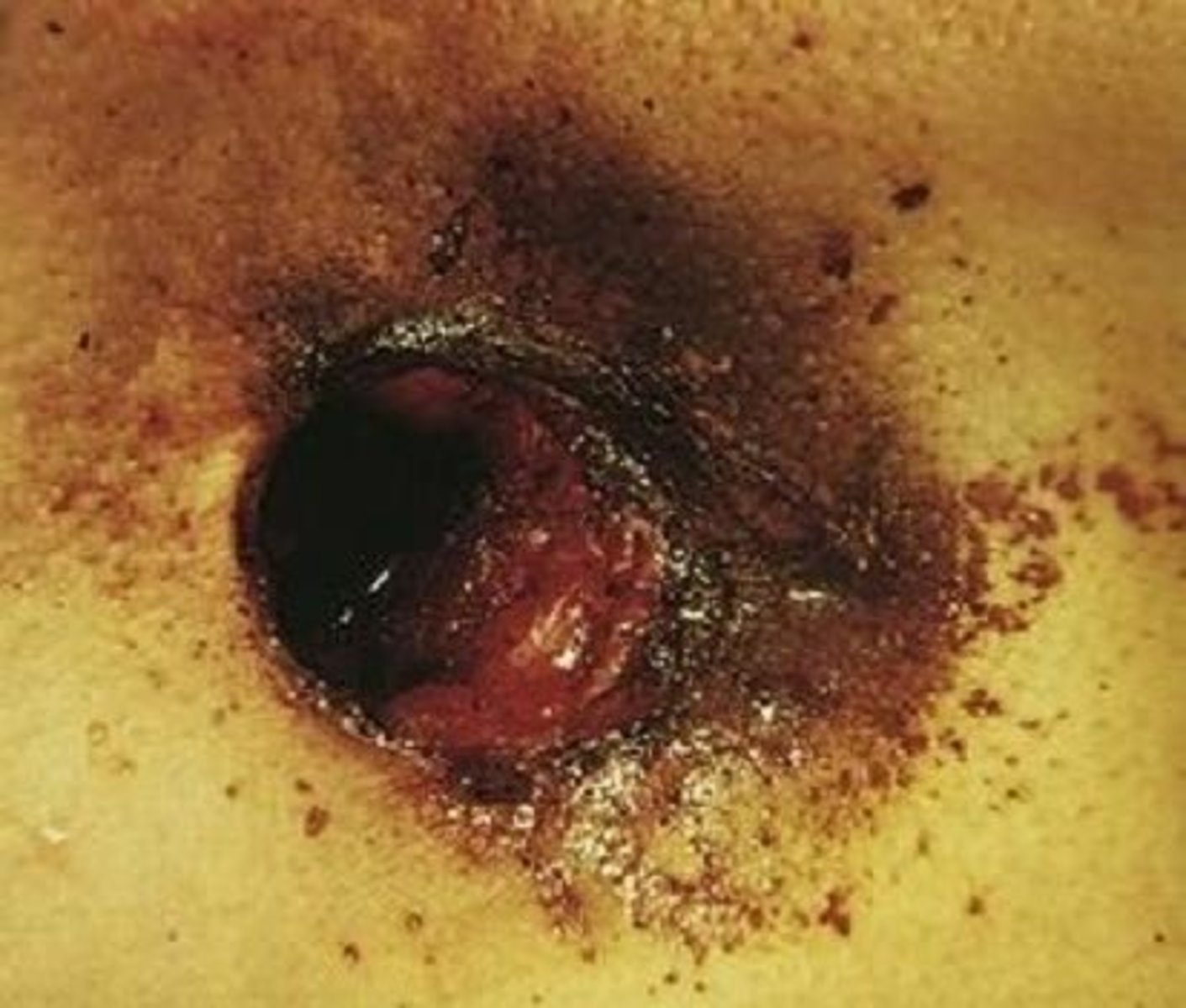 <p>the muzzle of the gun touches the skin, clear muzzle imprint, gray black discoloration</p>