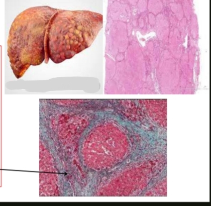 <p>What condition is shown and what causes it? What special stain is used and what does it highlight”arrow refer to it”?</p>