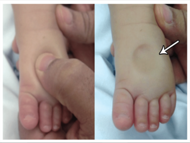 <ul><li><p><span>What type of edema is shown in the right image?</span></p></li><li><p><span>How would you grade it? The depth and amount of time it takes to resolve would be provided in the exam question. </span></p></li></ul><p></p>