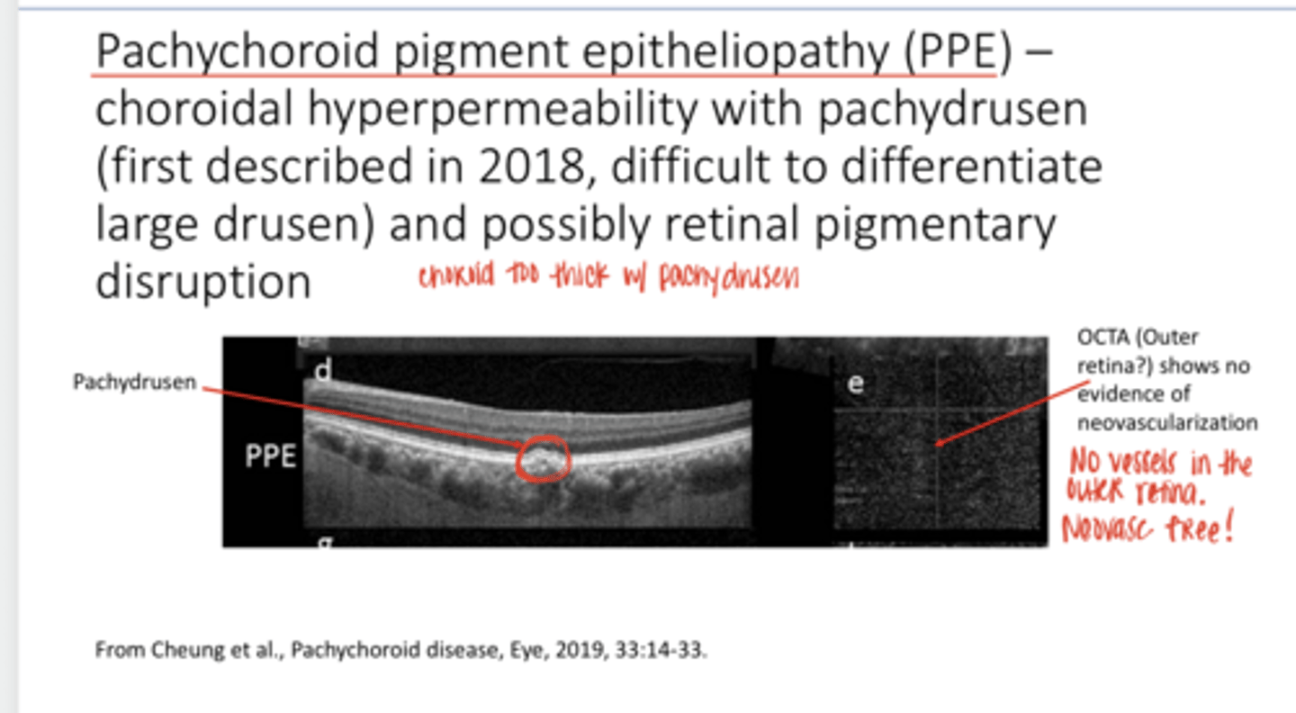 <p>On OCT-A will there be vessels in the outer retina of a patient with Pachychoroidal Pigment Epithelialopathy?</p>