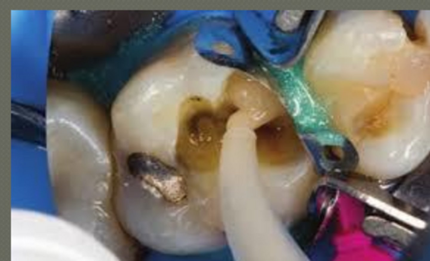 <p>- remove from mixer &amp; load into GC capsule applier III</p><p>- 2 clicks to prime the capsule then syringe</p><p>- within 10 secs of mixing, extrude mixture directly into prep.</p><p>- form preliminary contour</p><p>moist dentin (no dessication)</p><p>working time ~ 1:15 mins from start of mixing at 23</p><p>avoid moisture contamination first 2.5 min</p><p>*higher temps will shorten working time*</p>