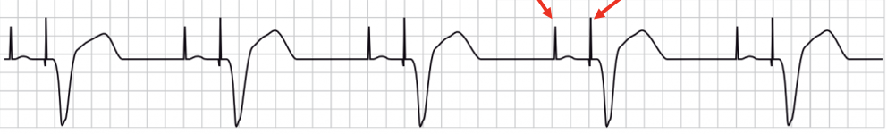 <p>pacer spike preceding P wave; 2nd pacer spike followed by a wide QRS and contralateral T wave</p>