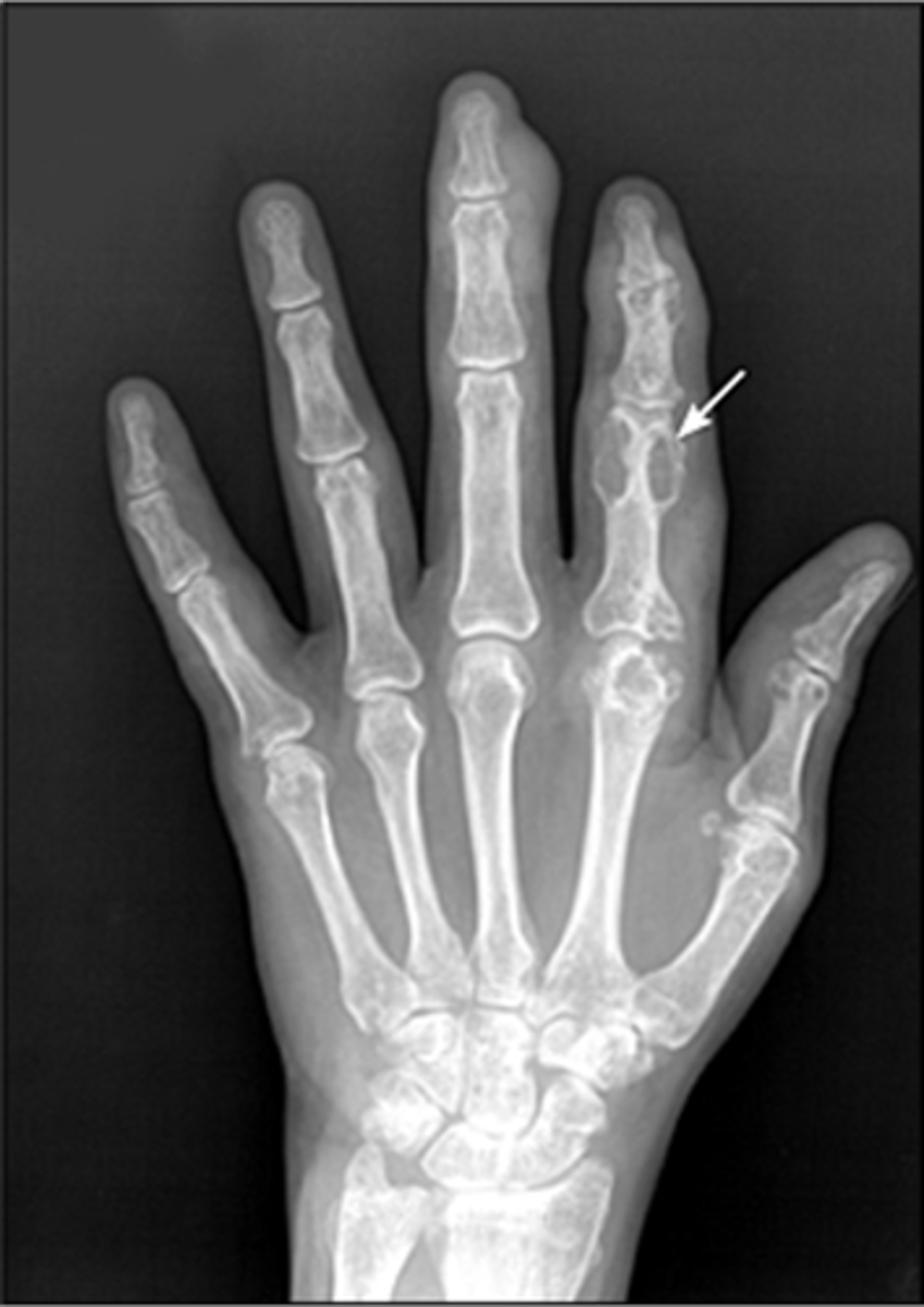 <p>Relative preservation of joint space with well-marginated erosions away from the joint</p>