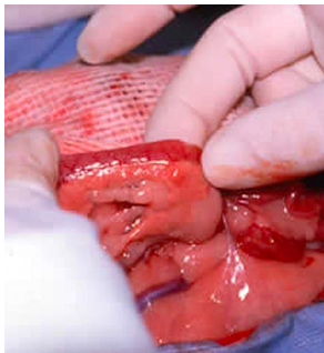 <p>insulinomas in dogs (rare in cats): beta-islet cell tumors</p>