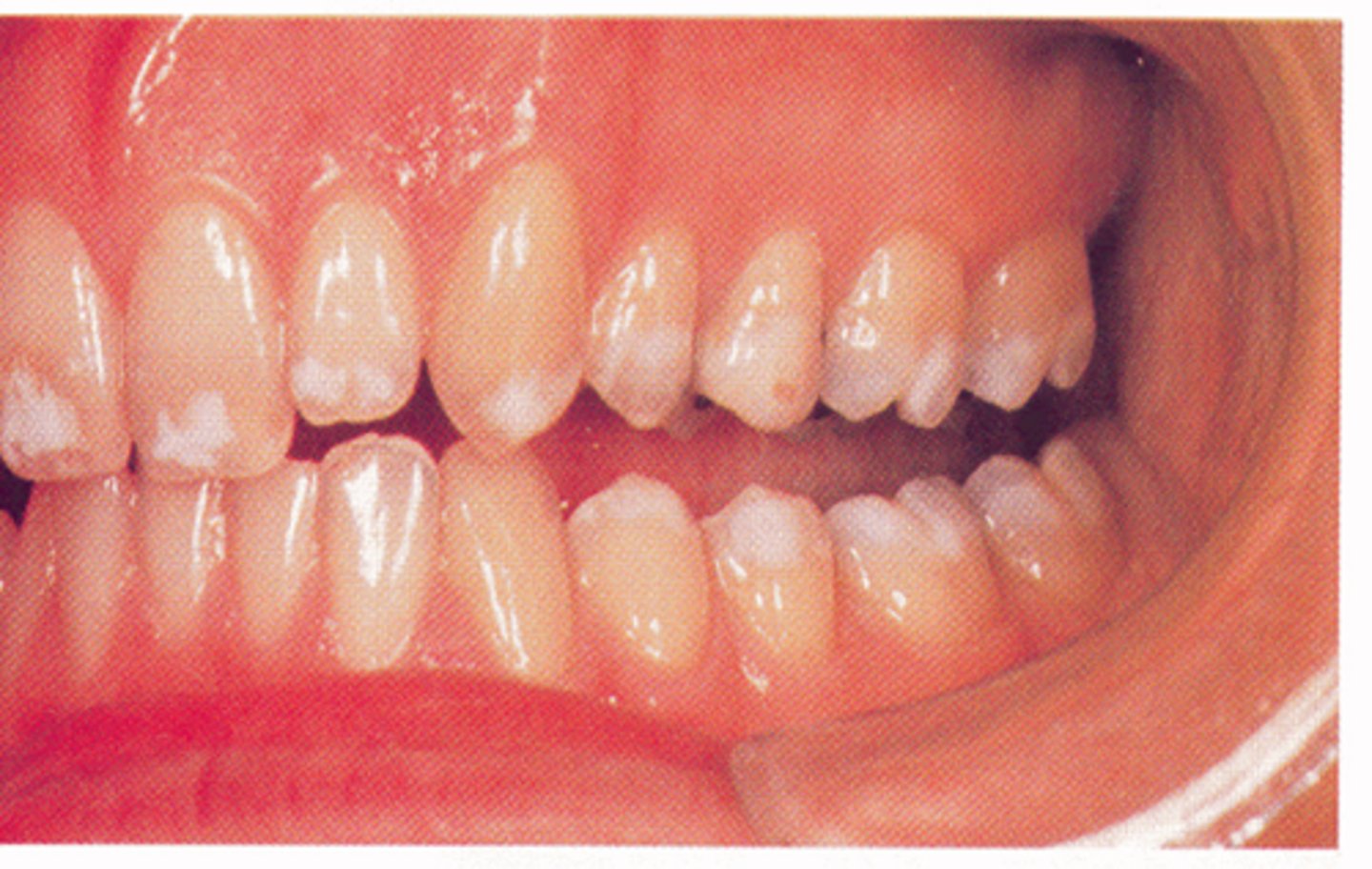 <p>1. Enamel is softer than normal</p><p>2. "Snowcapped"</p>