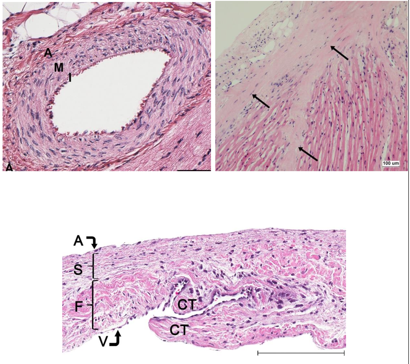 <p><span>Stains nucleic acids and cytoplasm blue brown or black. Stains proteins within cytoplasm and extracellular matrix pink to red. In the myocardium, nuclei are blue-black and muscle fibers are pink- red.</span></p><p><span>Upper Image Left: Normal coronary artery.</span></p><p><span>Upper Image Right: Subendocardial fibrosis (arrows) in the papillary muscle of a dog with DMVD.</span></p><p><span>Bottom Image: Mitral valve leaflet</span></p>