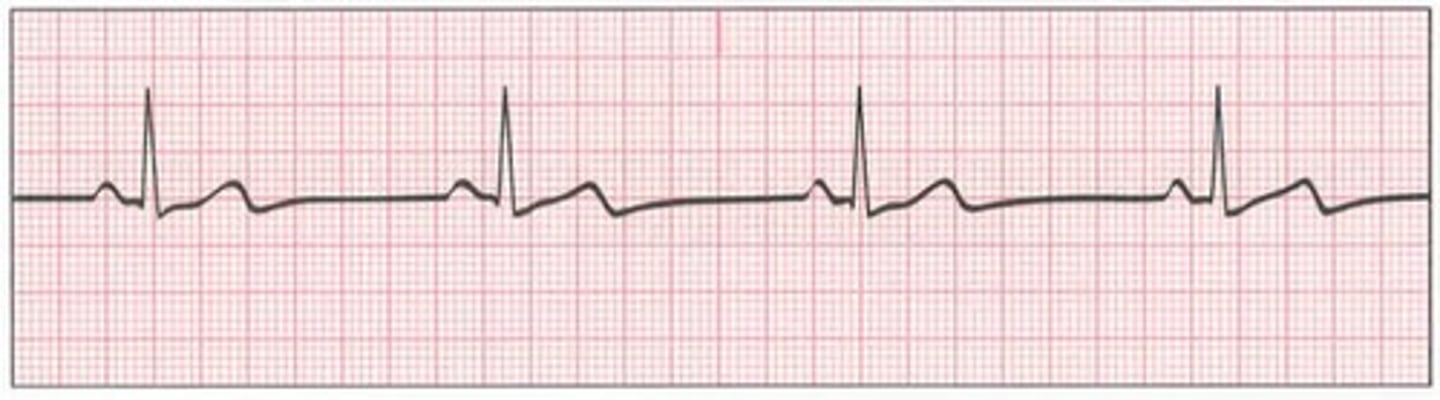 <p>- sinus rhythm where the SA node fires at < 60 BPM</p><p>- S/S: hypotension, pale skin, weakness, angina, syncope, confusion, SOB</p><p>- Treatment: atropine (increases HR), pacemaker, d/c offending medications</p>