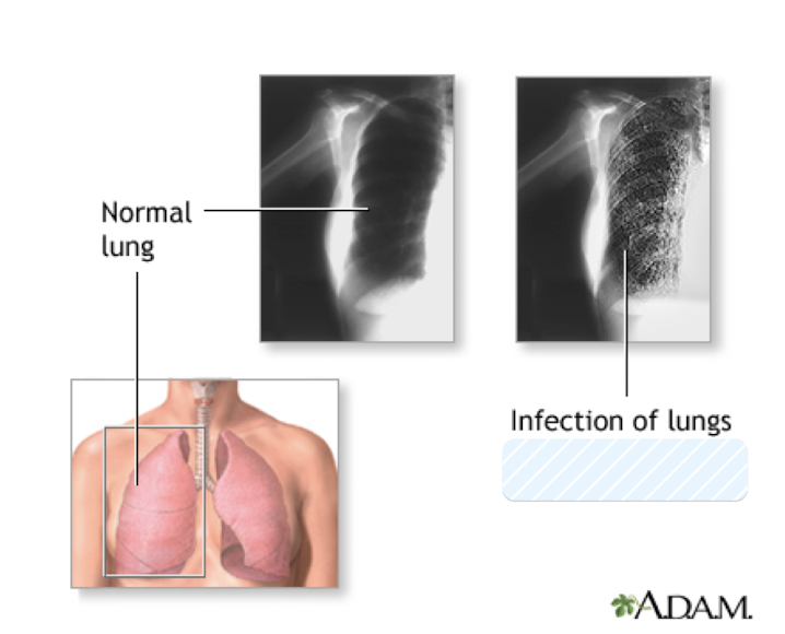 <p>Which <strong>fungal</strong> <strong>infection</strong> presents like a virus on chest x-ray and is successfully treated with an <strong>antibiotic (TMP/SMX- Bactrim)</strong>?</p><ul><li><p>almost 100% fatal if untreated</p></li><li><p>common disease in AIDS patients/immunocompromised</p></li></ul>