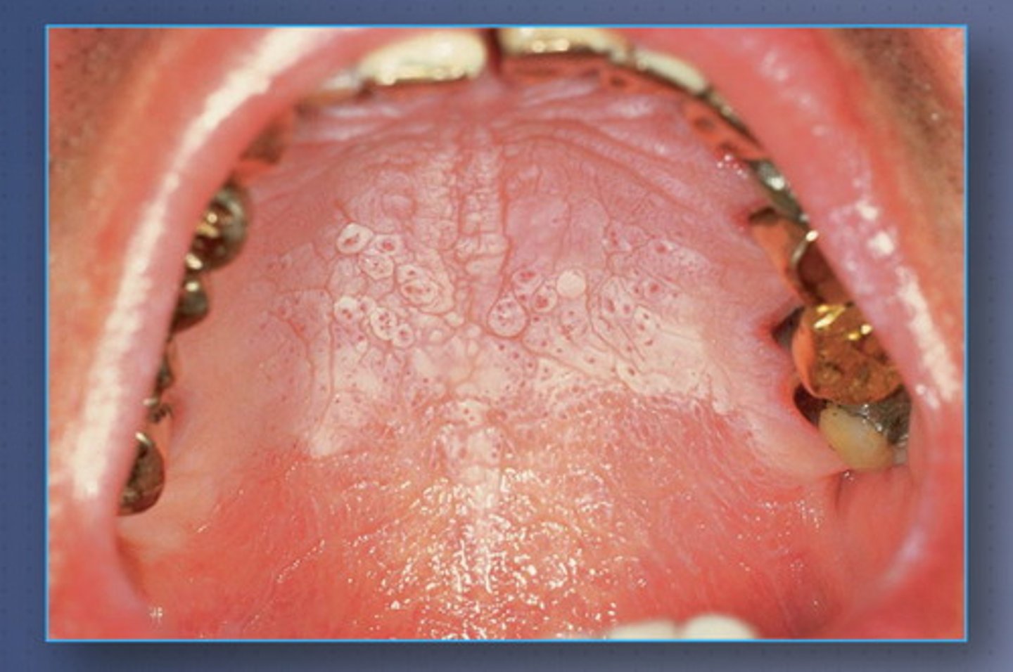 <p>usually causes by the heat from smoking, vaping, or even from very hot liquids</p><p>- inflammation of the minor salivary ducts of the soft palate</p>