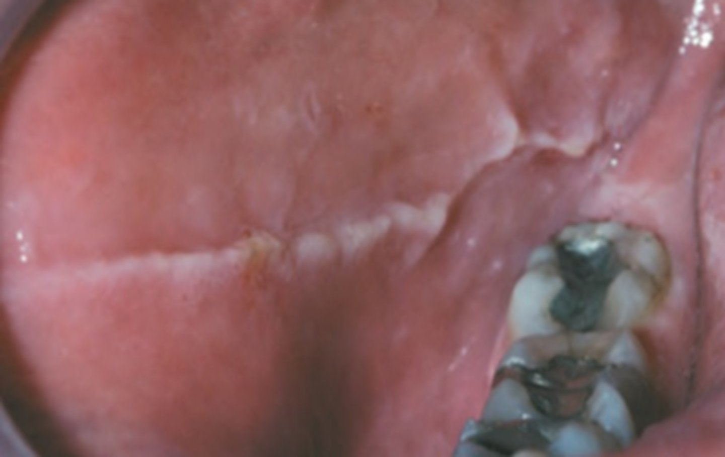 <p>along occlusal plane of buccal mucosa</p>