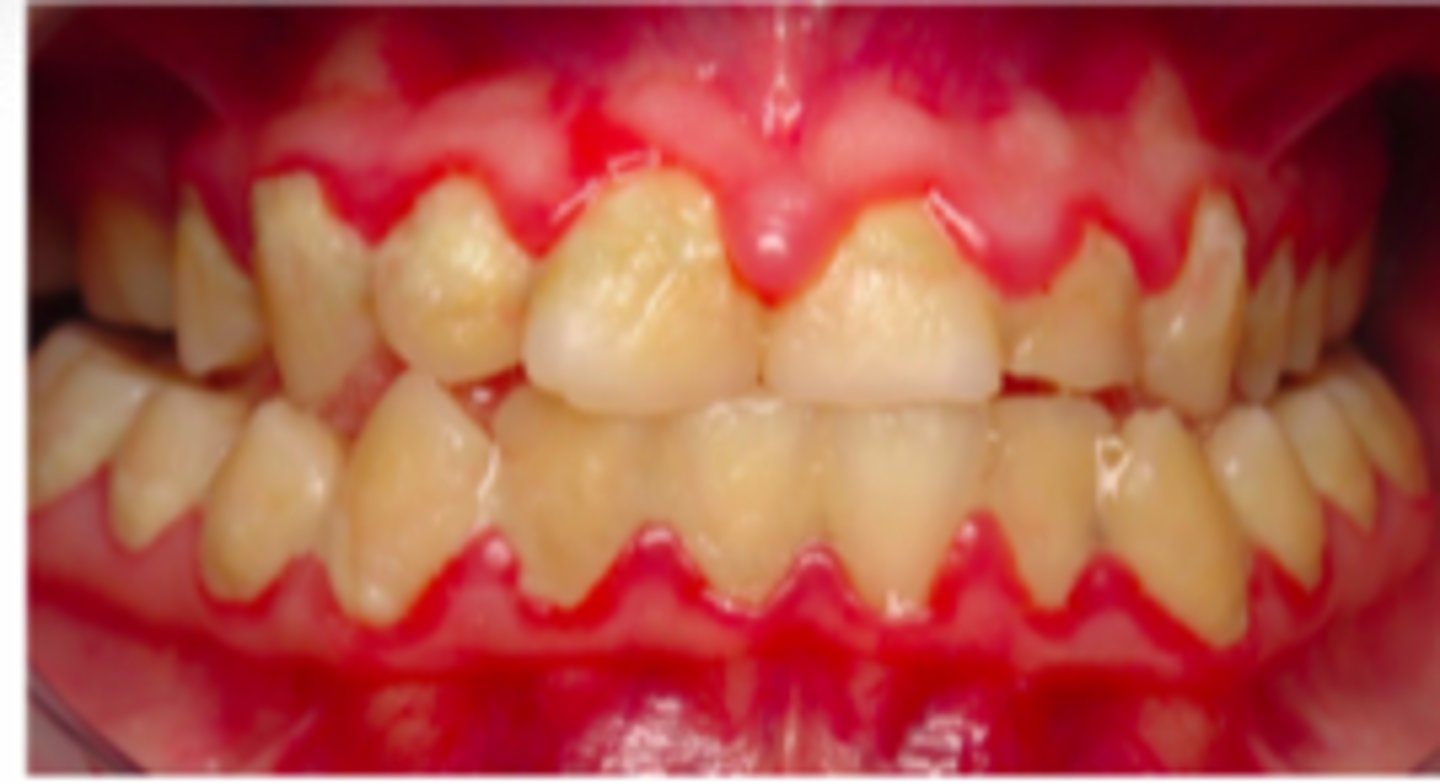<p>Tandköttsinflammation där ansamling av bakterier driver inflammationsprocessen som resulterar i att tandköttsfickan blir djupare, tandköttet svullnar och vi får utsöndring av gingivalexudat</p>