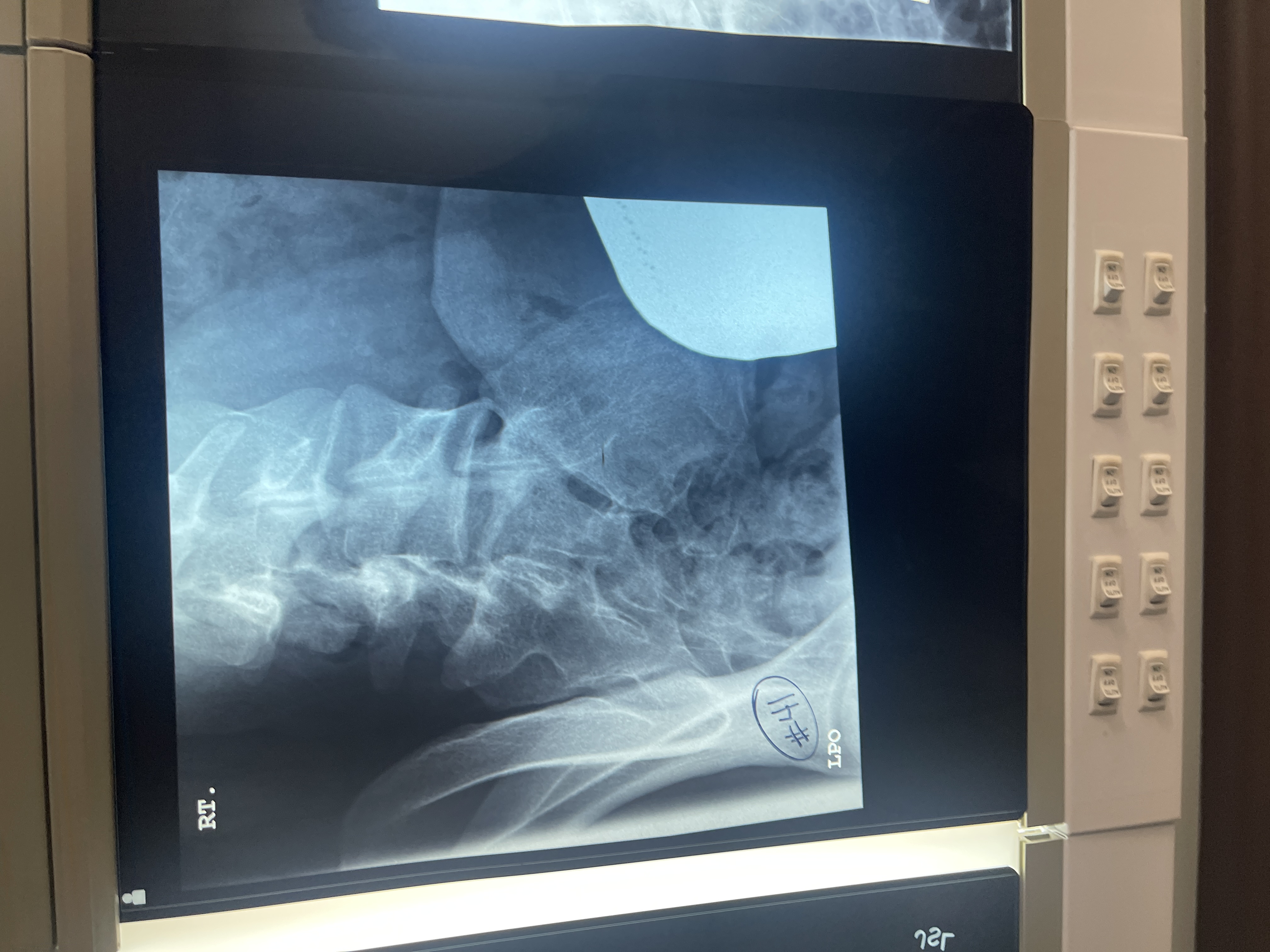 <p>What’s wrong with #41 AP axial oblique of the right SI joint</p>