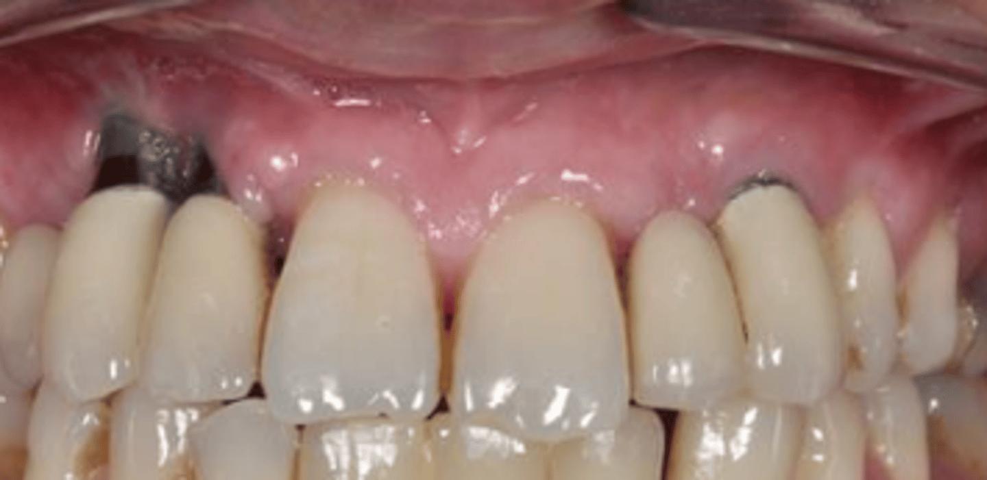 <p>• Prosthetic Errors</p><p>• Soft tissue deficiencies:</p><p>&gt; Pre-existing </p><p>&gt; Labial recession/uneven contour </p><p>&gt; Lack of papillae</p><p>3D implant position</p>