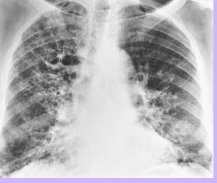 <p>this is bronchiectasis, what is this RA</p>