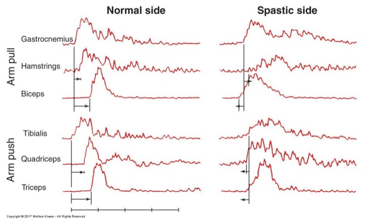 <p>loss of anticipatory processes that activate postural adjustments in advance of potentially destabilizing voluntary movements</p><p>dependent on previous experience &amp; learning</p><p>activating muscles before stabilized→destabilization in anticipated motion</p>