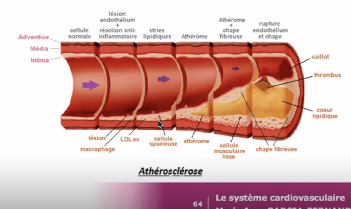 <p>Rupture de la média et nécrose de cette tunique —>dilatation progressive de l’artère aboutissant à la constitution d’un anévrisme </p><ul><li><p>+++ anévrisme de l’aorte abdominale sous les artères rénales </p></li></ul><p></p>