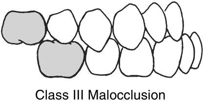 <p>Class III malocclusion</p>