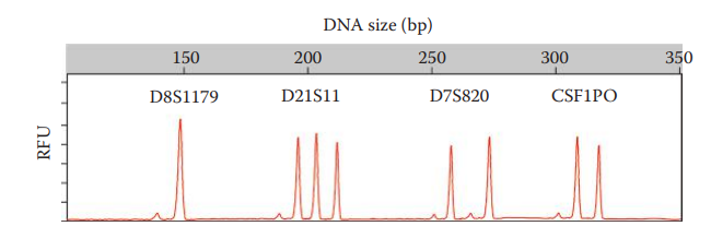 Triallele. In this example, the triallele is observed only at D21S11 and not at other STR loci.