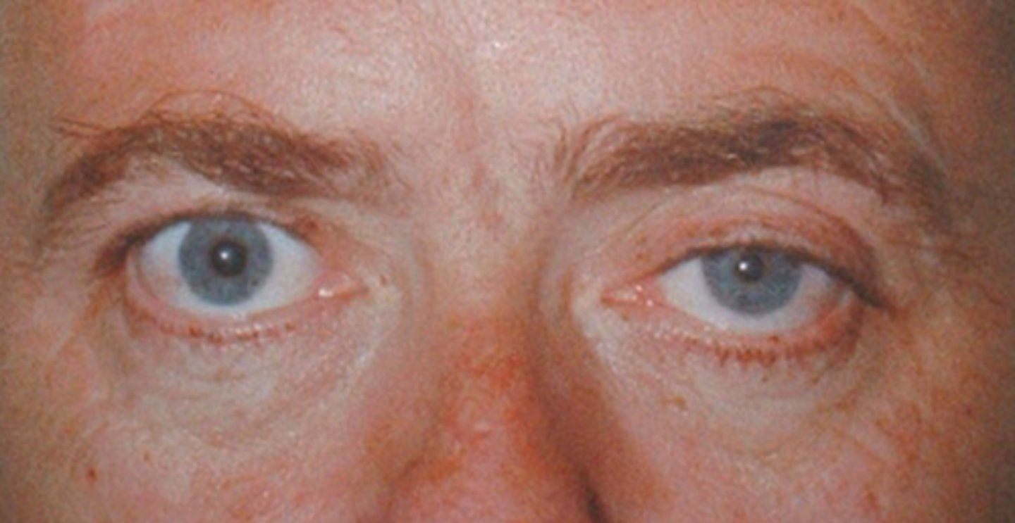 <p>Horner's syndrome (symp issue) will show...</p><p>ptosis due to Muller's affected</p><p>small pupil = miosis</p><p>anhydrosis</p>