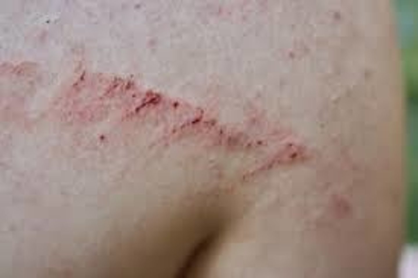 <p>Loss of epidermis caused by urine or stool on the skin (diaper rash)</p>