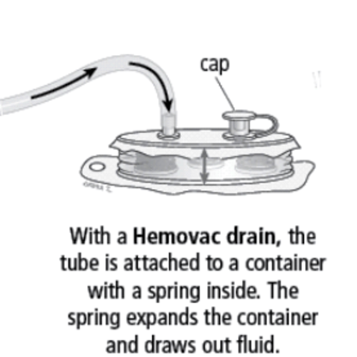 <p>Hemovac drains are more common in _______________________. If in place, don't be very aggressive /c ROM. These are also ________________________ drains.</p>