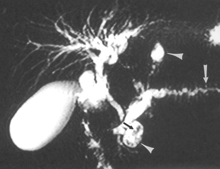 <p>Chain of lakes sign - dilatation &amp; tortuosity of the main pancreatic duct </p>