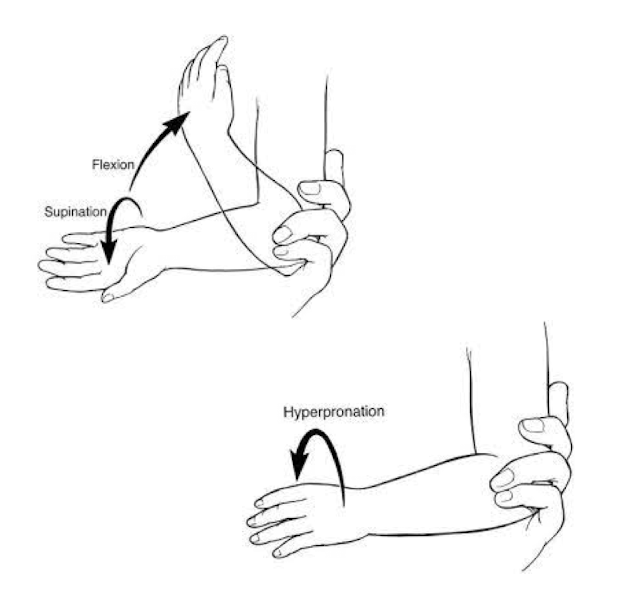 <p><span><strong>radial head subluxes with axial traction due to underdeveloped annual ligament</strong> w/ pull to lift, grabbing to catch fall, tantrums</span><br><span><strong>very common 1-4yo,</strong> less common&gt;5yo</span></p><p><span>PE: arm in slight flexion, pronated with <strong>no</strong> <strong>swelling</strong>; <strong>pain with any flexion or supination</strong>; <em>r/o bony tenderness or deformity (supracondylar fracture)</em></span><br><span>Dx: clinical diagnosis, imaging unnecessary unless concern for fracture/atypical</span></p><p>Tx: reduce in clinic (hyperpronation or flexion/supination), pt ed. for high recurrence rate</p>
