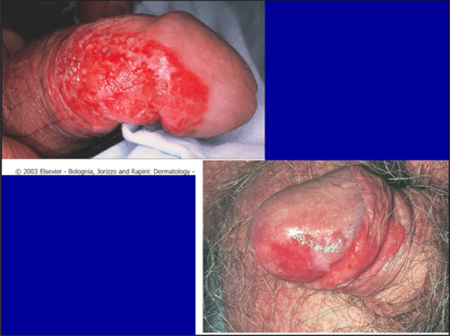 <p>Appears as reddish plaques of the glans of the penis </p>