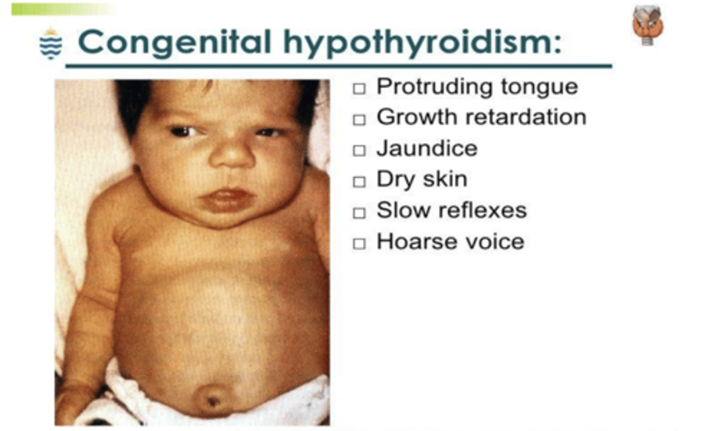 <p>thyroid hormone is essential for normal growth and development. untreated cases cause mental retardation and impairment of physical growth - manifestations here are referred to as cretinism. </p>