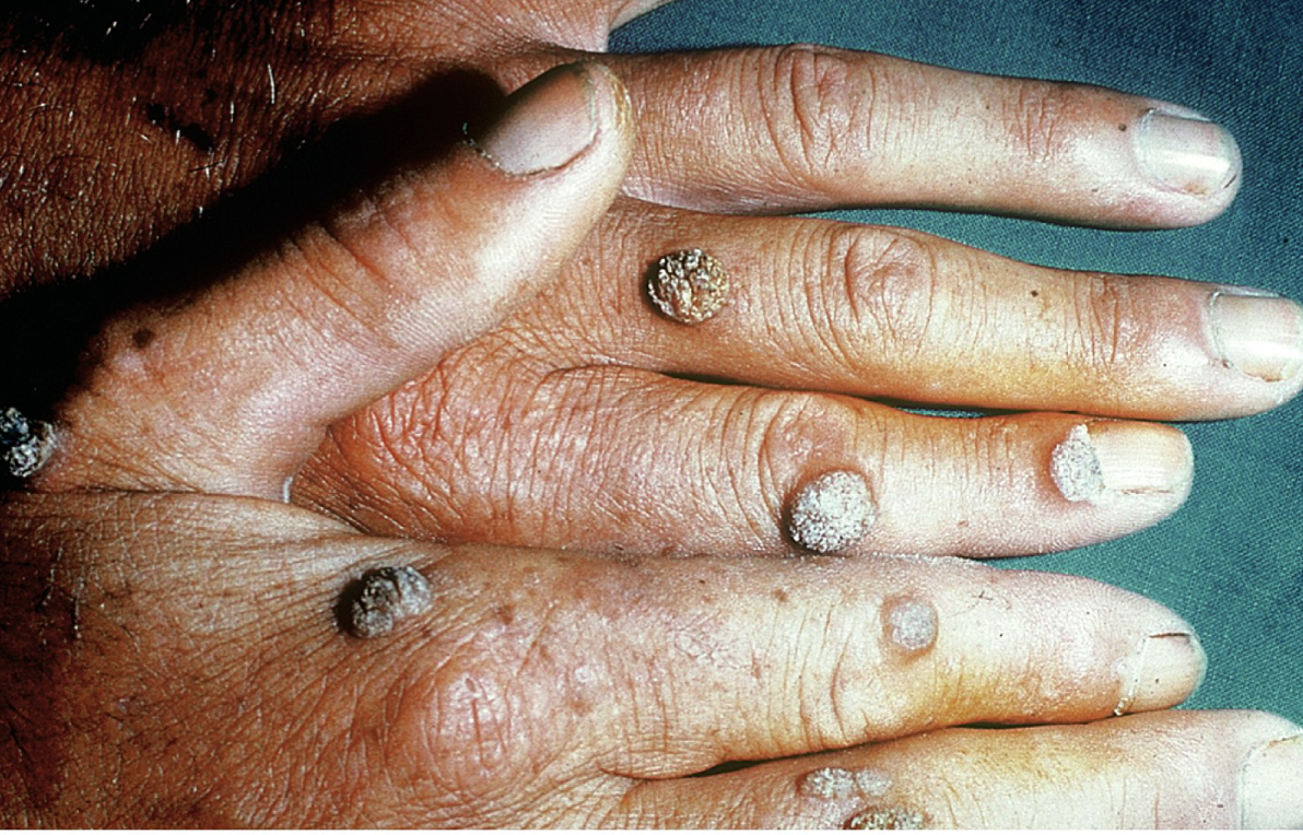 * Caused by human papillomavirus (HPV) 
* May be dermal or genital 
* Usually treated with salicylic acid or liquid nitrogen (cryotherapy), but extreme cases may require laser removal 

\
