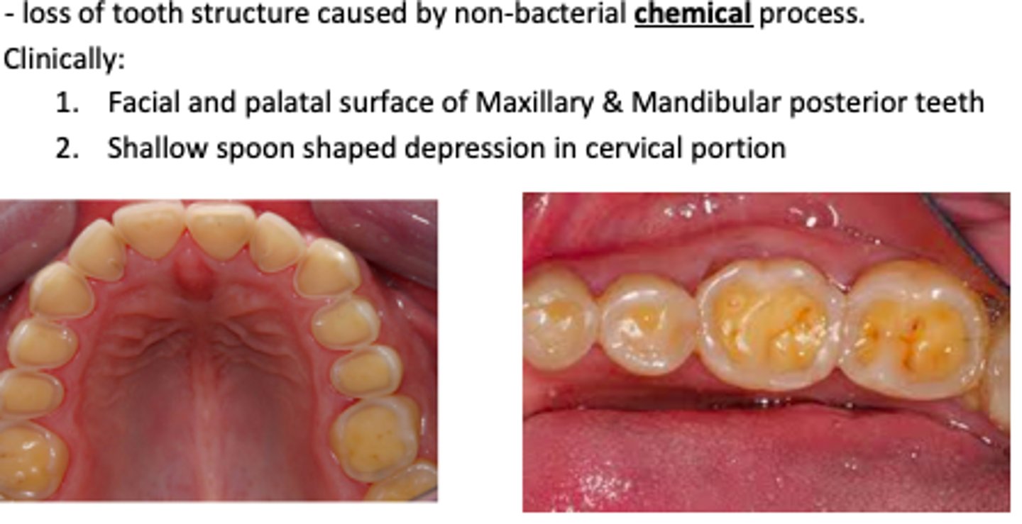 <p>Loss of tooth structure caused by non-bacterial chemical process (acid) </p><p>Clinically:</p><p>Facial and palatal surface of Maxillary &amp; Mandibular posterior teeth</p><p>Shallow spoon shaped depression in cervical portio</p>