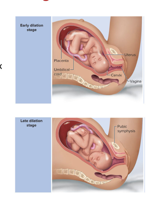 <ul><li><p>the longest stage</p><ul><li><p>lasting 8 to 24 hours</p></li></ul></li><li><p>Cervical canal dilates to 10 cm </p></li><li><p>effacement (thinning) of cervix occurs </p></li><li><p>Fetal membranes rupture and amniotic fluid is lost</p><ul><li><p>“water breaking”</p></li></ul></li><li><p>Late dilation </p><ul><li><p>dilation reaches 10 cm in 24 hours or less in primipara and in as little as a few minutes in multipara</p></li></ul></li></ul><p></p>
