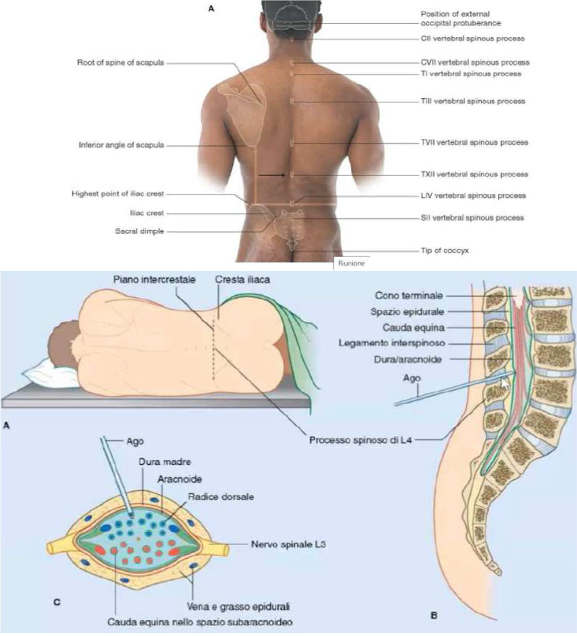 <p>Procedura che permette:</p><ul><li><p>prelievo del liquor dallo spazio subaracnoideo</p></li><li><p>somministrazione farmaci o anestetici</p></li></ul><p>Sede:</p><ul><li><p>Sotto il cono midollare per evitare rischio danneggiamento midollo</p></li><li><p>Livello ideale tra L3-4 o L4-5</p></li></ul><p>Individuare la sede:</p><ul><li><p>Palpare la linea che unisce le due creste iliache → passa circa a livello del processo spinoso di L4</p></li><li><p>Angolo inferiore della scapola è a livello di T7, mentre il punto più alto della cresta iliaca corrisponde a L4, la metà tra questi indica T12, dove termina il midollo</p></li></ul><p>Posizione del paziente:</p><ul><li><p>seduto piegato in avanti o sdraiato su un fianco in posizione fetale</p></li><li><p>questo serve per allargare gli spazi interlaminari e facilitare il passaggio dell’ago</p></li></ul><p></p>