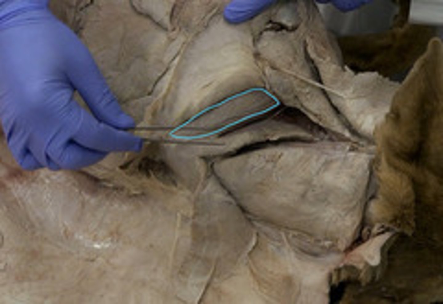 <p>Origen: fosa supraespinoso</p><p>Inserción: tubérculo mayor del húmero.</p><p>Función: Extensor del hombro y abductor</p><p>Inervación: n. supraescapular.</p>