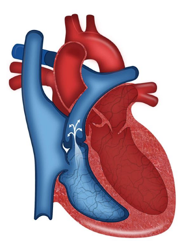 __**● Defect:**__  

○ Narrowing of the pulmonary artery  

○ Makes it harder for the RV to pump, causes hypertrophy 

__**● History:**__  

○ Often asymptomatic; as progressed DOE and fatigue develop 

__**● Specific assessment findings**__  

○ Dyspnea on exertion 

○ Murmur  

__**● Treatment**__  

○ Pulmonary valvotomy  

○ Moderate to severe stenosis: child should avoid high intensity  activities. 