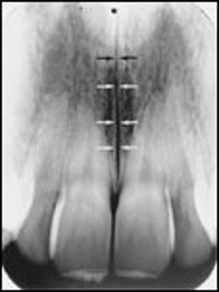 <p>What is the radiolucent structure seen here?</p>