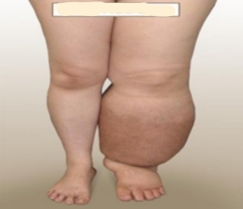 <p>What type of edema is shown and what are its causes?</p>