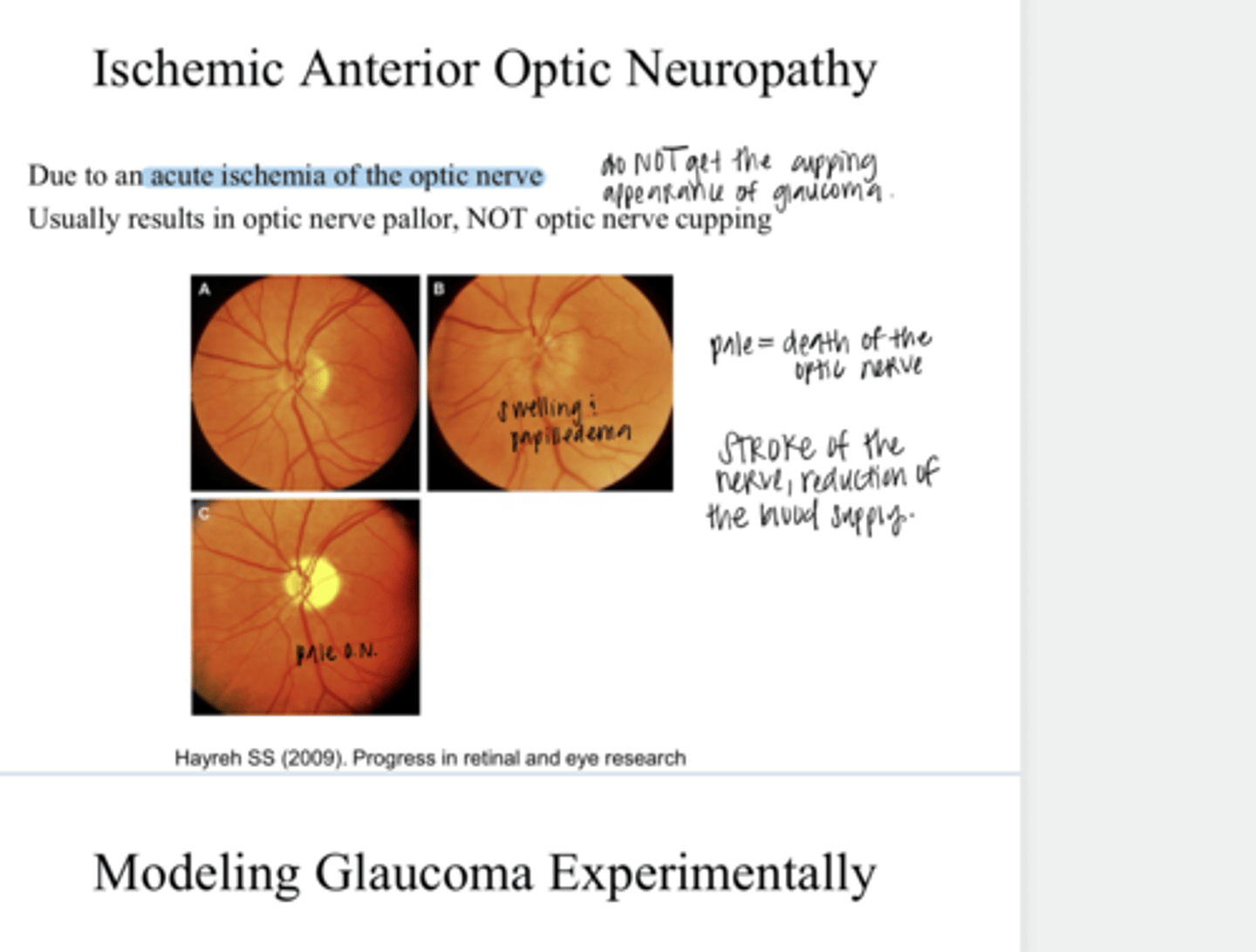 <p>What does ischemic anterior optic neuropathy result in?</p>