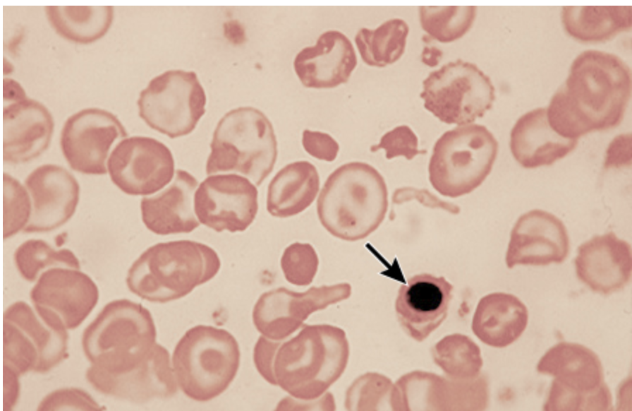 <p>Labs for Thalassemia</p>
