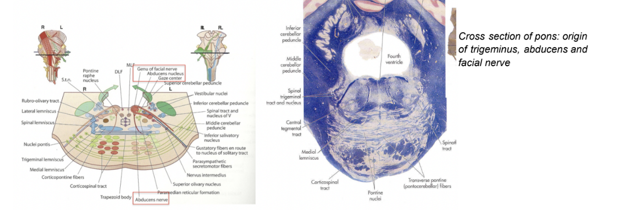 <ul><li><p>6th cranial nerve, innervating <u>lateral rectus</u> muscle (extraocular) — located in metencephalon (pons) </p></li><li><p>Only has a <u>somatic general efferent</u> component (GSE) </p></li><li><p>Originates from the pons, with its motor nucleus very clos to the midline &amp; very superficial — so much so that it forms a protrusion of the floor of the 4th ventricle</p><ul><li><p>Moreover, close to it — motor nucleus of facial nerve, whose fibers run over the abducens nucleus as they exit the brainstem — </p></li><li><p>Loop formed by fibers of facial nerve around nucleus of abducens nerve — <u>Genu</u> of the facial nerve</p><ul><li><p>Also protrudes at level of floor of 4th ventricle</p></li></ul></li></ul></li></ul>
