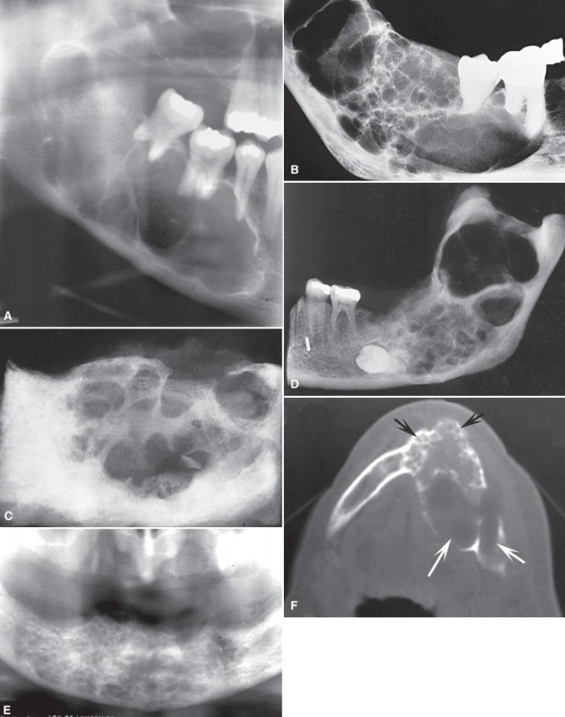 <ul><li><p>Large multilocular lesion in the mandible. Note the coarse, curved septa</p></li><li><p>Small loculations more common in the anterior mandible (black arrows) and the larger loculations in the posterior mandible white arrows).</p></li><li><p>Note expansion and perforation of borders</p></li></ul><p></p>