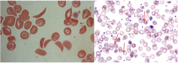<p>Crescent-shaped sickle RBCs</p><p>Howel-Jolly Bodies: Basophilic DNA remnants in immature RBCs</p><ul><li><p>Indicate splenic dysfunction</p></li></ul><p></p>